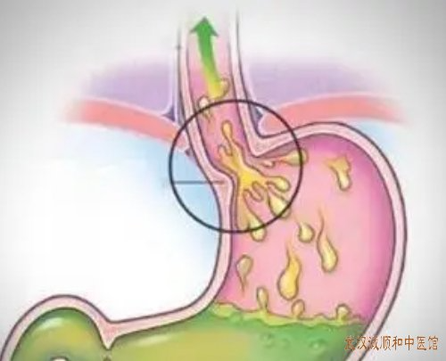 武汉珞瑜东路脾胃科老中医门诊部：糜烂性胃炎伴胆汁反流咽部不适口苦干中药怎么治好？